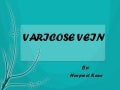 varicose vein