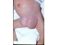 1. generalidades de hernias
