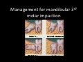 Impacted Mandibular 3rd Molar & other teeth than 3rd molar