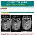 Case record...Hemimegalencephaly