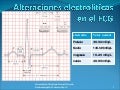 Alteraciones ElectrolíTicas En El Ecg