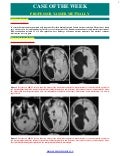 Case of the week: Cases presented with cortical dysplasia