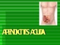 Apendicitis aguda