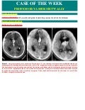 Case record...Ruptured anterior communicating aneurysm