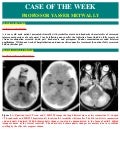 Case record...Postinfectious cerebellitis