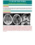 Case record... Septo-optic dysplasia