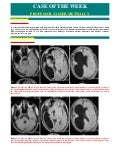 Case record...Aicardi syndrome