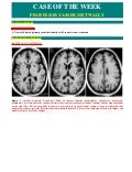 Case record...Cortical dysplasia
