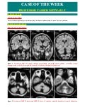 Case record...Cortical/cerebellar dysplasia