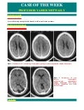 Case record...Cortical dysplasia