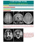 Case record...Dysembryoplastic neuroepithelial tumor
