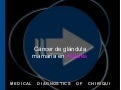 Cáncer de mama, v1.5