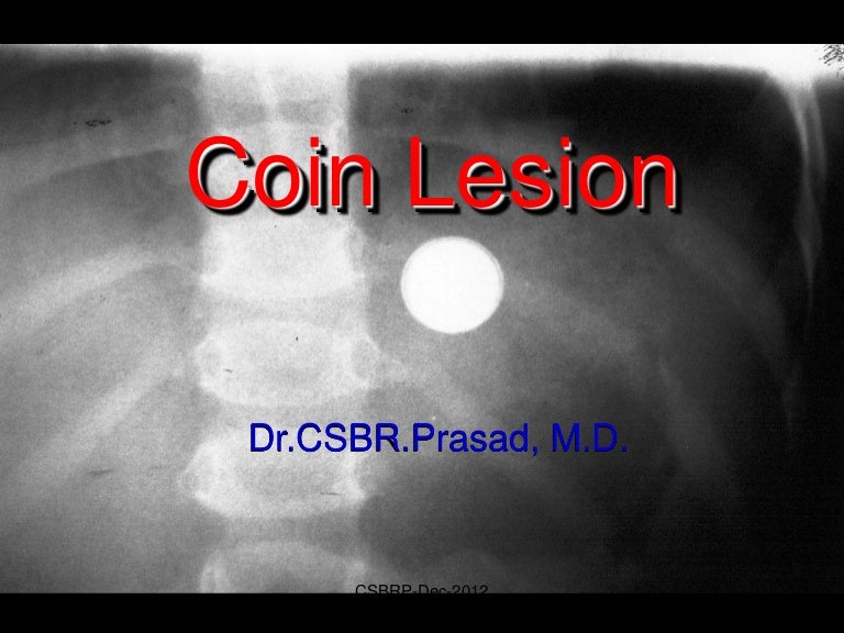 Coin lesion