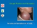 Cirugía Plástica en el Quemado. Secuelas en el Cuello
