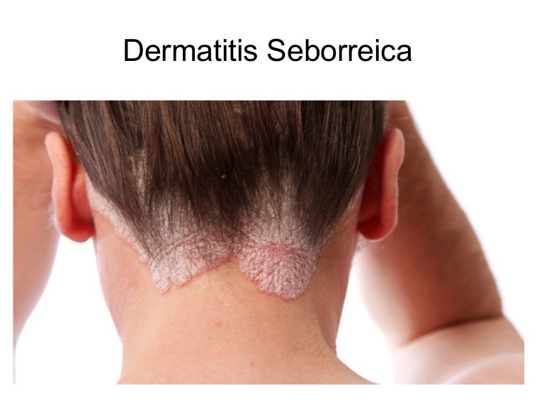 Dermatitis seborreica