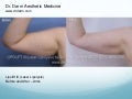 Dr. Darm Lipolift Before and After Arms