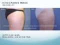 Dr. Darm Lipolift Before and After Thighs