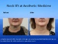 Dr. Darm, Neck lift before and after - M.M.
