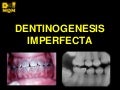 Dentinogénesis Imperfecta 