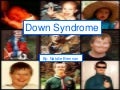 Down Syndrome
