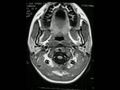 Freidriech's ataxia
