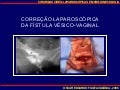 Correção Laparoscópica da Fístula Vésico-vaginal 