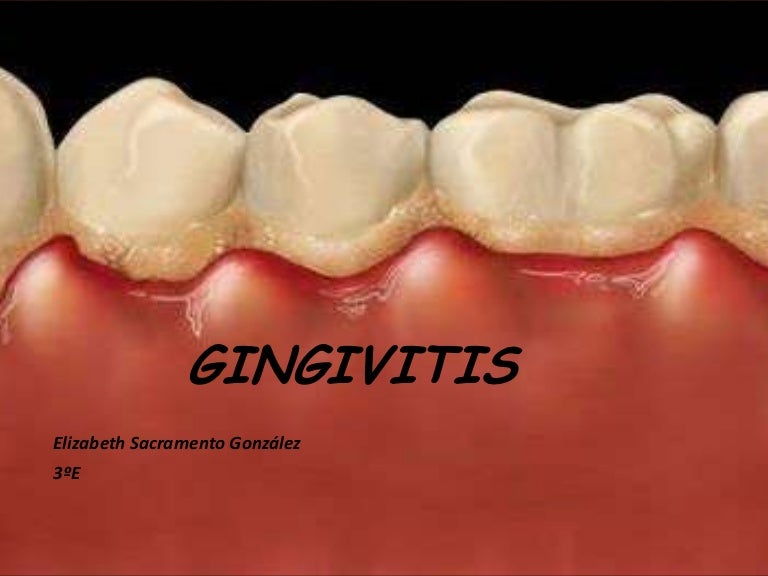 Гингивит У Взрослых Симптомы И Лечение Фото — Картинки фотографии