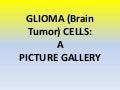 Glial (brain tumor) cells a picture gallery
