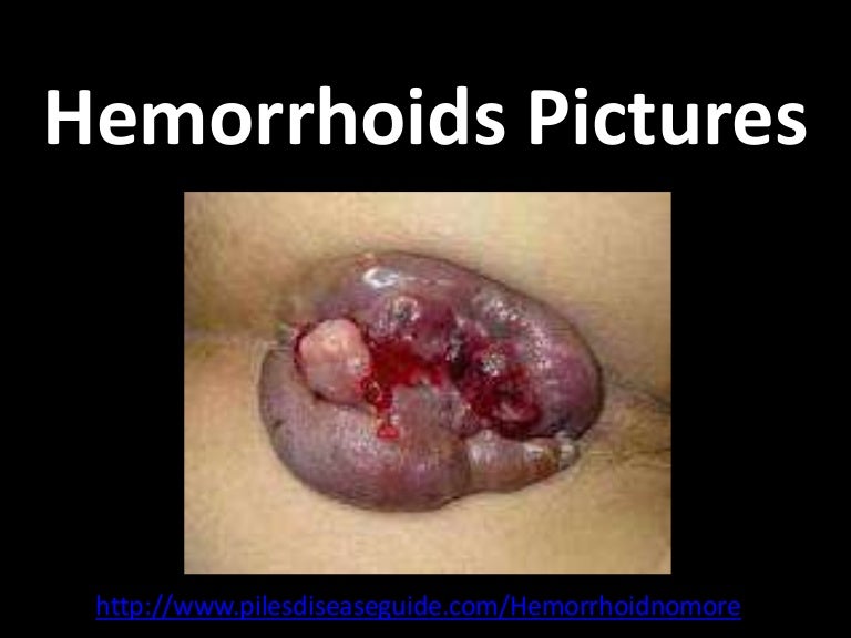 Hemorrhoids pictures
