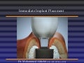 Immediate implant lecture