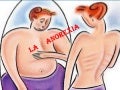 La anorexia