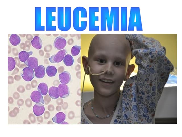 Leucemia
