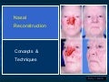 Nasalreconstructiongrandrounds043009