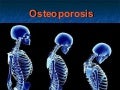 Osteoporosis