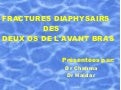 fractures diaphysaires des os de l'avant bras