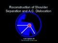 Reconstruction of Shoulder Separation and A.C. Dislocation