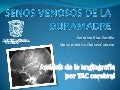 ANATOMIA DE LOS SENOS VENOSOS DE LA DURAMADRE