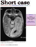 Shortcase...Hemimegalencephaly