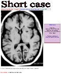 Short case...Cortical dysplasia