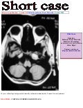 Short case...Cortical/cerebellar dysplasia