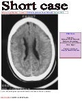Short case...Cortical dysplasia