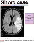 Short case...Dysembryoplastic neuroepithelial tumor