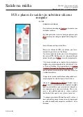 Sus e planos de saúde vão substituir silicone rompido