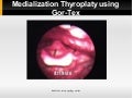 Thyroplasty