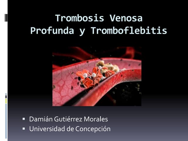 Tromboflebitis Superficial