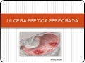 Ulcera peptica perforada