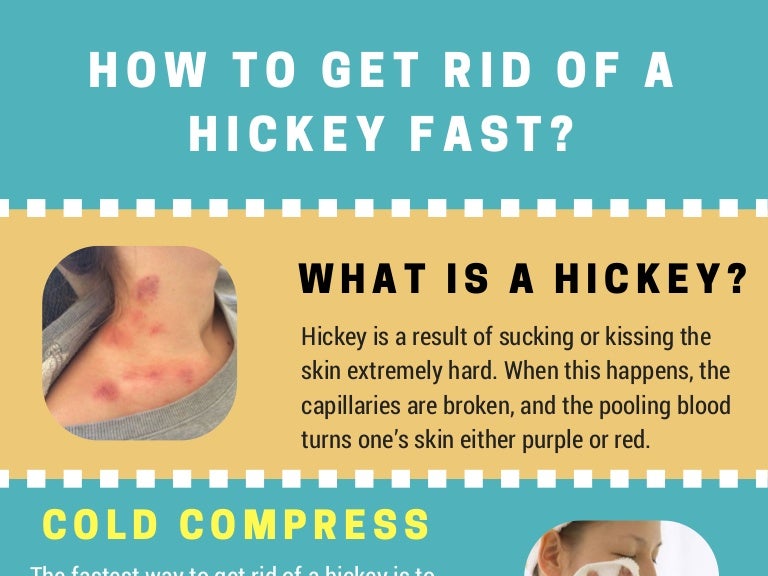How to get rid of hickey