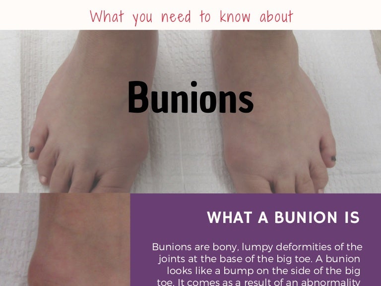 What You Need To Know About Bunions
