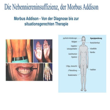 01.12 Nebennierenerkrankungen. Die Nebenniereninsuffizienz. Der Morbus ...