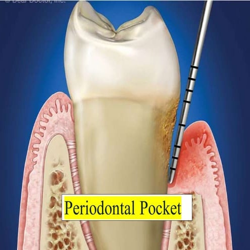 periodontal pocket